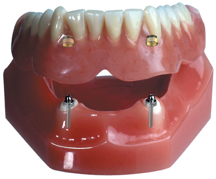 Dr Anil Da Silva's Dental Clinic | High Impact Fiberglass Partial Dentures