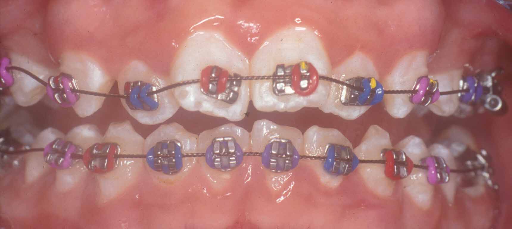 treating improper teeths