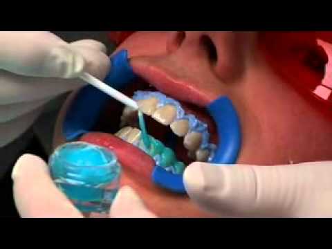 teeth whitenning process